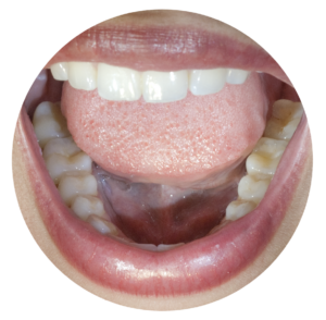 ingrandimento x2.5 occhiale ingrandente galileiano
