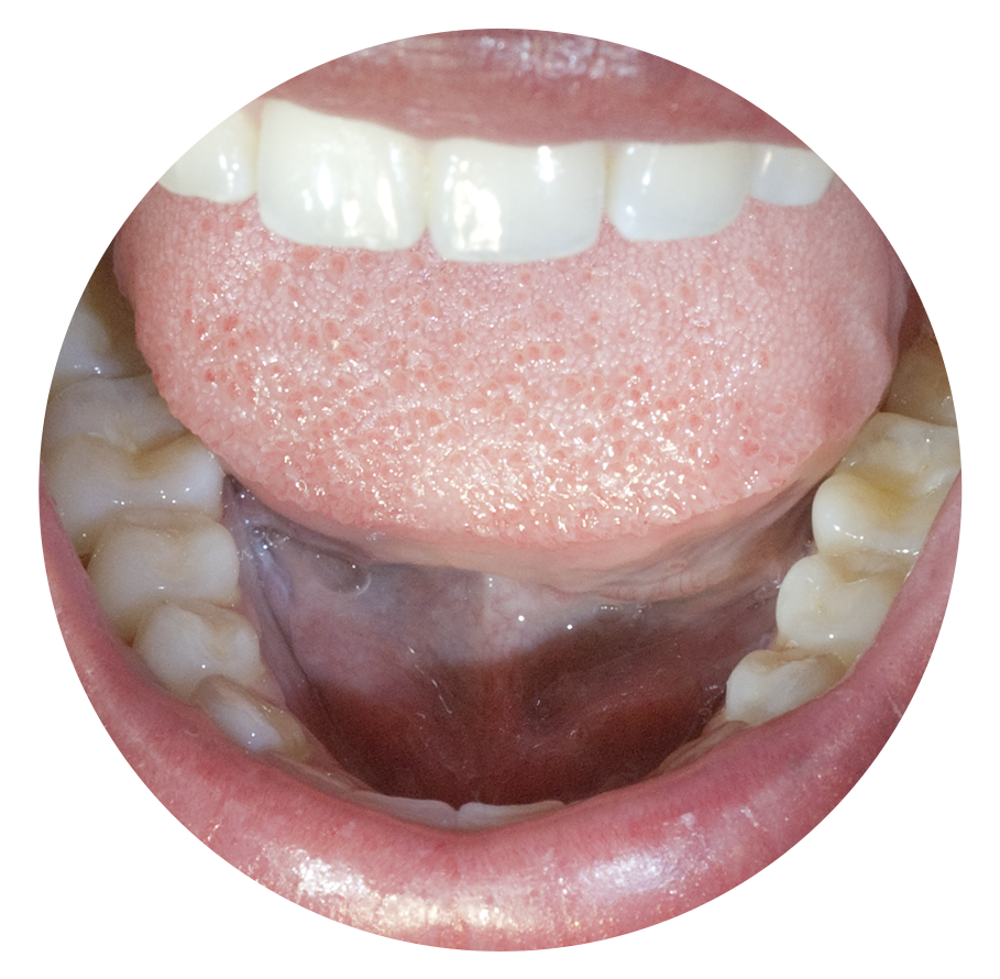 ingrandimento x3.0 occhiale ingrandente galileiano