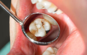 ingrandimento dente cariato con specchietto da dentista
